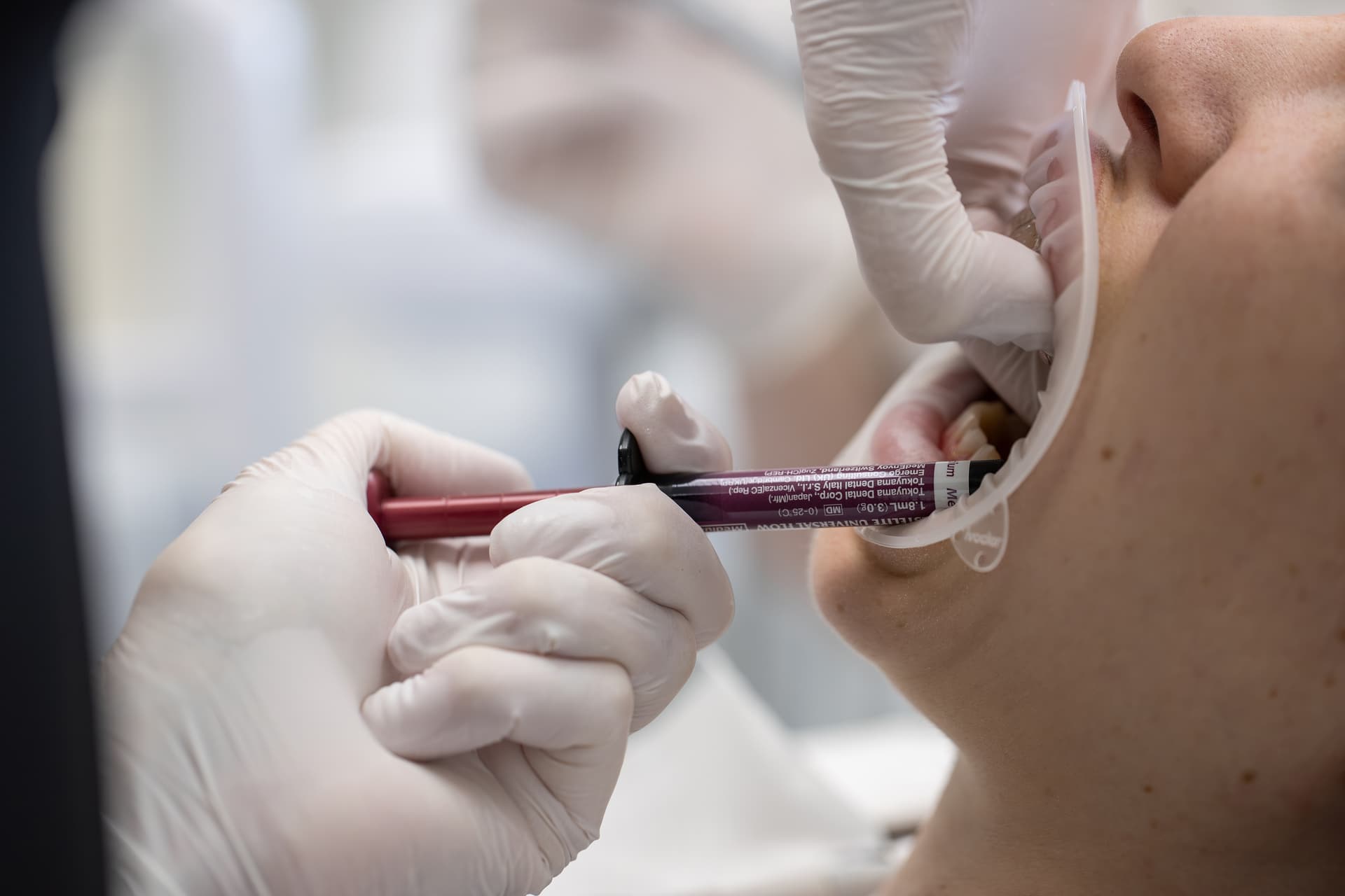 Aplikacja materiału kompozytowego przez nakładkę podczas zabiegu flow injection – Gerczew Stomatologia