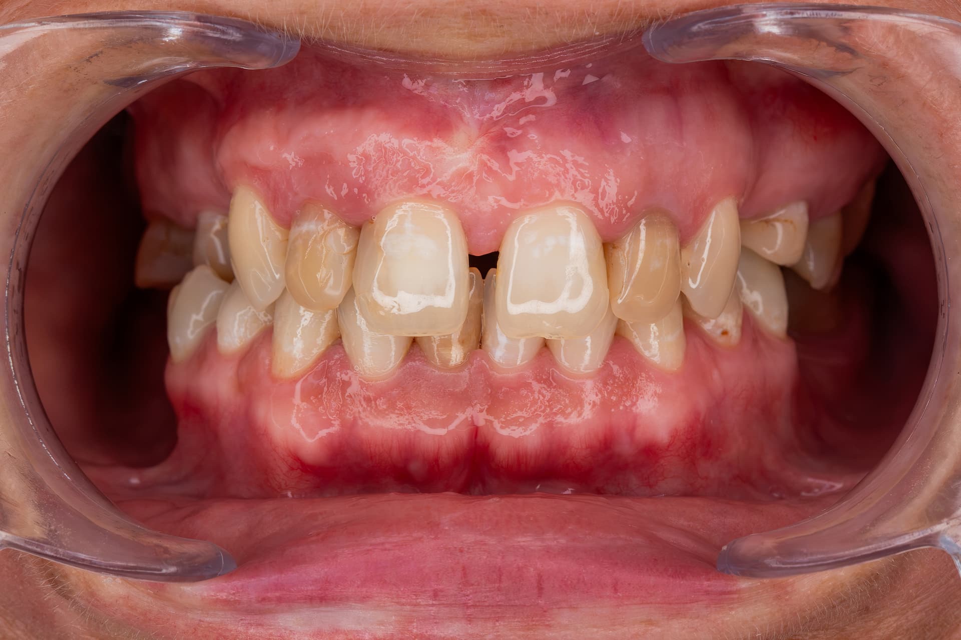 Stan zębów przed leczeniem – diastema i przebarwienia po leczeniu kanałowym – Gerczew Stomatologia