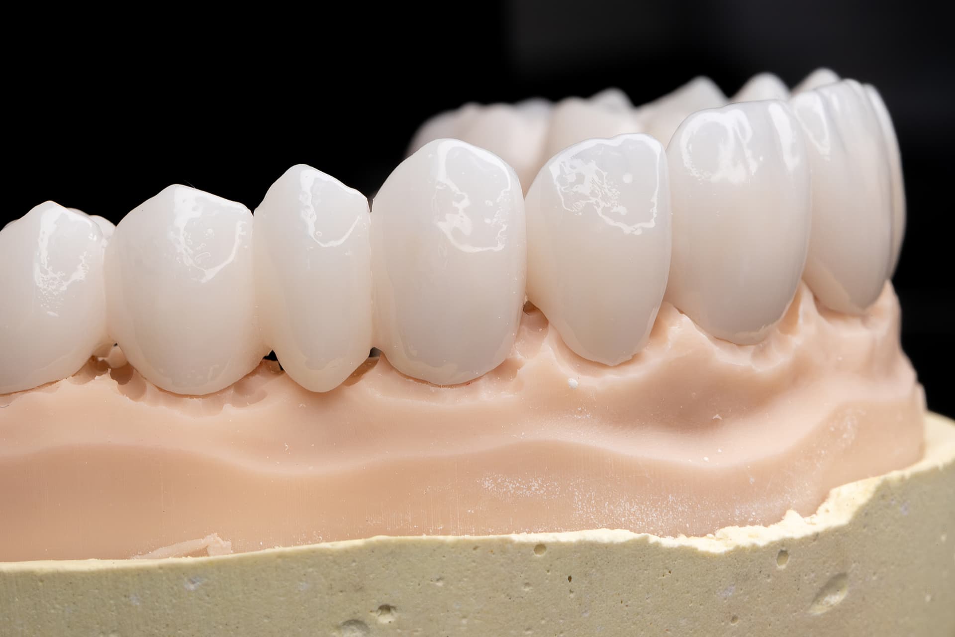 Korony pełnoceramiczne na modelu – rekonstrukcja szczęki – Gerczew Stomatologia